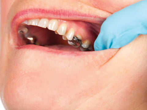 Candida and Mercury in amalgam dental fillings